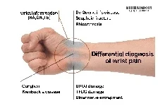 تشخیص افتراقی های مچ درد (ویژه دانشجویان پزشکی)