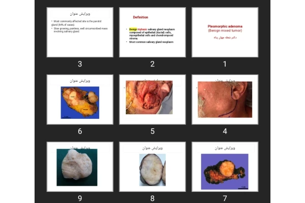 پاورپوینت Pleomorphic adenoma (Benign mixed tumor)