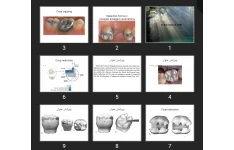 پاورپوینت Retention forms in Complex amalgam restorations