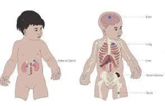 دانلود پاورپوینت نوروبلاستوما اطفال