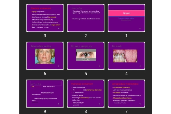 پاورپوینت شوگرن Sjogren