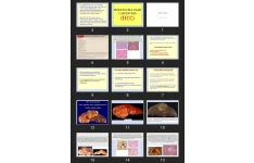 پاورپوینت HEPATOCELLULAR CARCINOMA (HCC)