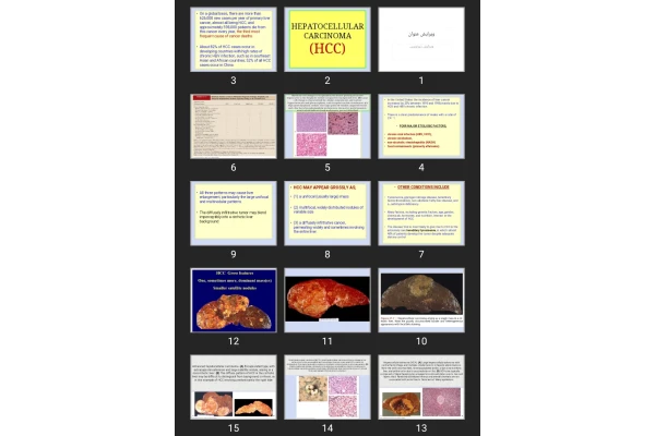 پاورپوینت HEPATOCELLULAR CARCINOMA (HCC)