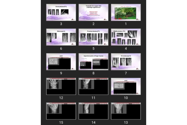 پاورپوینت Traumatic fx in upper limb (radiologic appearance)