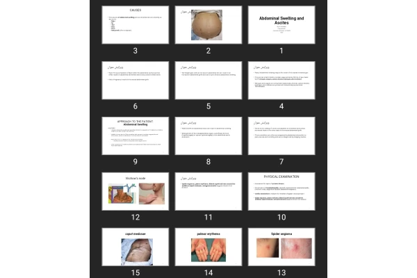 پاورپوینت Abdominal Swelling and Ascites