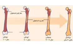   فایل سندرم نارسایی مغز استخوان